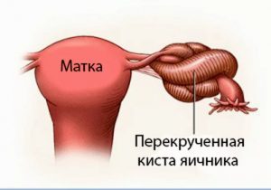 Перекрут ножки кисты