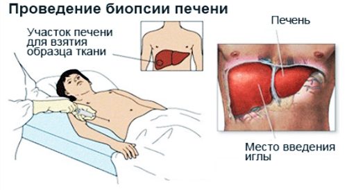 Проведение биопсии печени