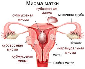 Миома матки