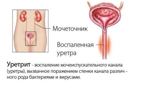 Чтобы отличить уретрит от цистита, после общего анализа мочи дополнительно проводят трехстаканную пробу урины, подразумевающую сбор трех разных порций мочи во время одного мочеиспускания