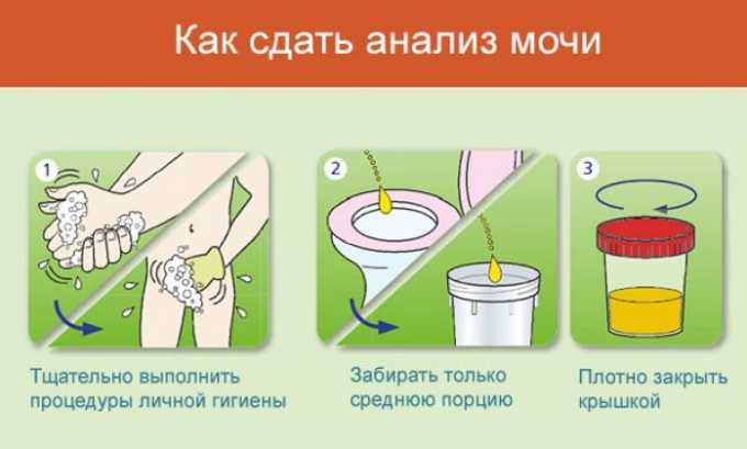 Уровень эпителиальных клеток в урине ребенка может повысится из-за несоблюдения правил сбора мочи