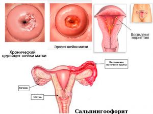 Осложнения кольпита