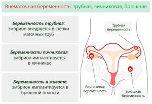 Виды внематочной беременности