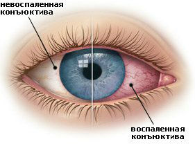 Конъюнктивит