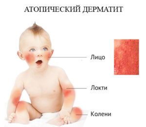 Атопический дерматит