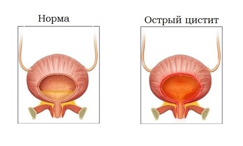 Жжение, зуд и боль при мочеиспускании у мужчин - это неизменные симптомы цистита