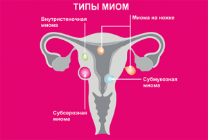 Типы миом