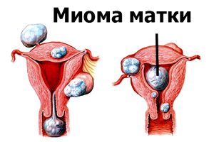 Схема миомы матки