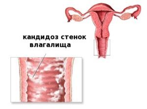 Вагинальный кандидоз