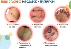 Виды опасных бородавок и папиллом