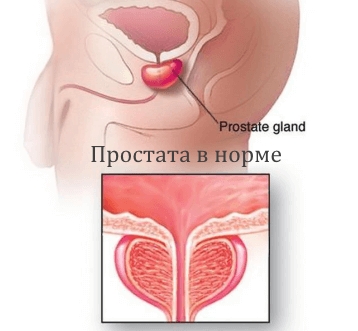 Излечение простаты
