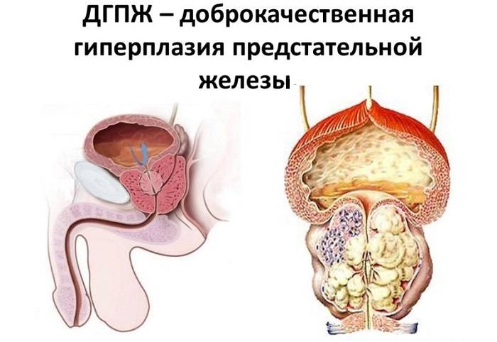 Доброкачественная гиперплазия предстательной железы