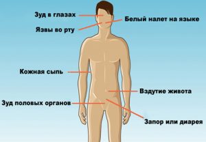 Симптомы молочницы у мужчин