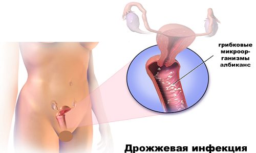 Молочница у женщин