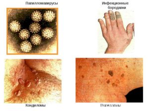 Виды новообразований