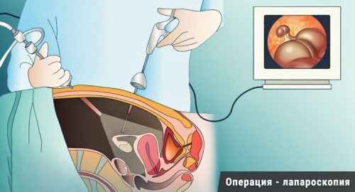 Лапароскопический метод