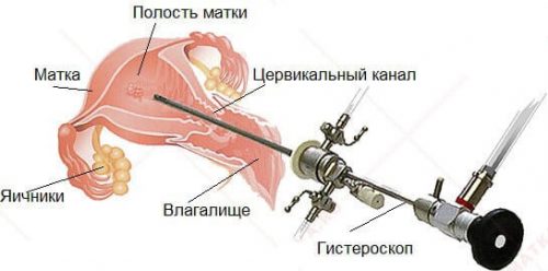 Гистероскопия