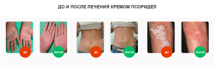 Последствия лечения Псоридел