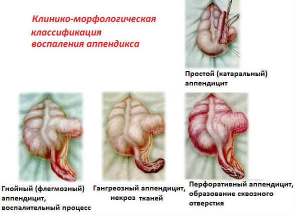 Классификация воспаления аппендикса