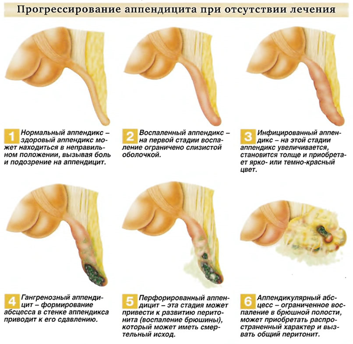 Последствия не лечения аппендицита