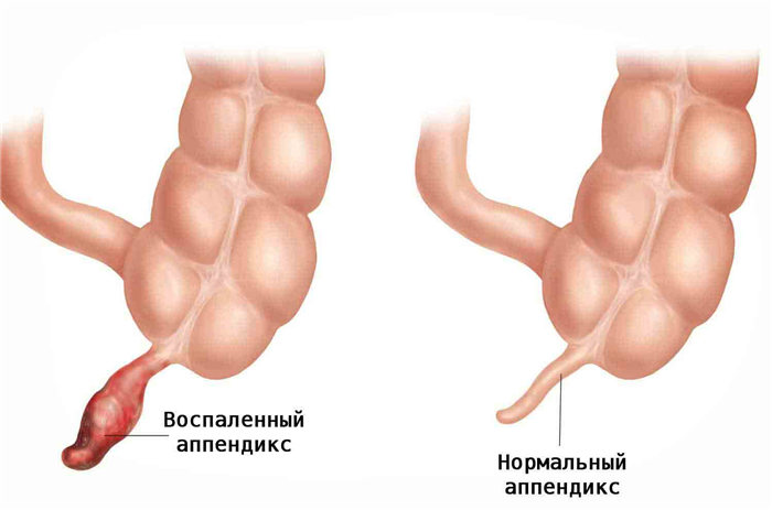 Воспаленный и нормальный аппендикс