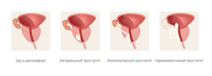 Стадии простатита