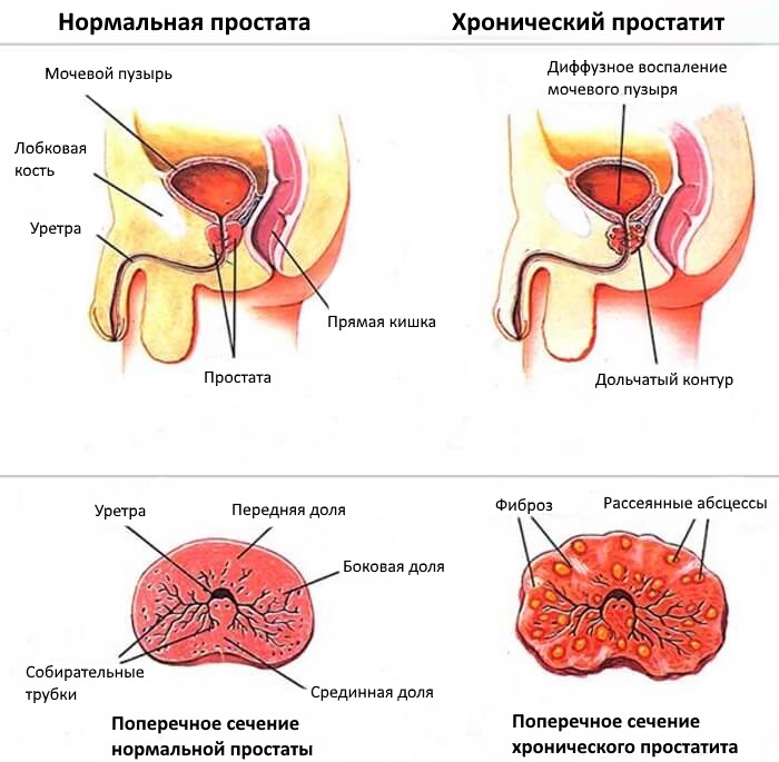 Хронический простатит