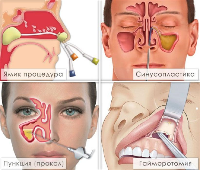 Процедуры при лечении гайморита
