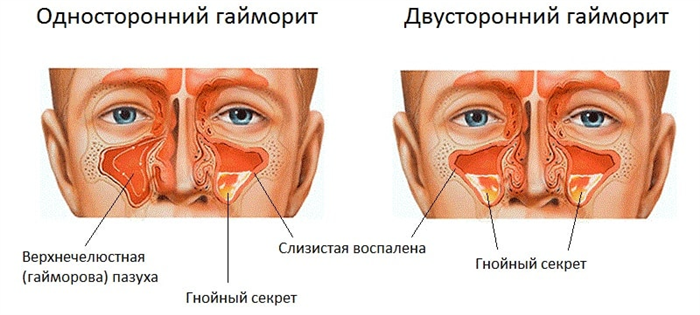 Односторонний и двусторонний гаймори