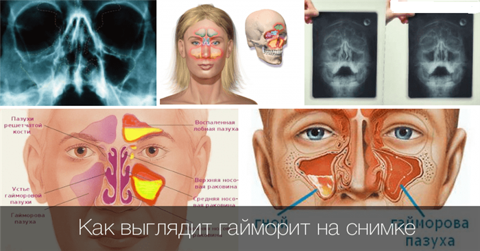 Гайморит на снимке