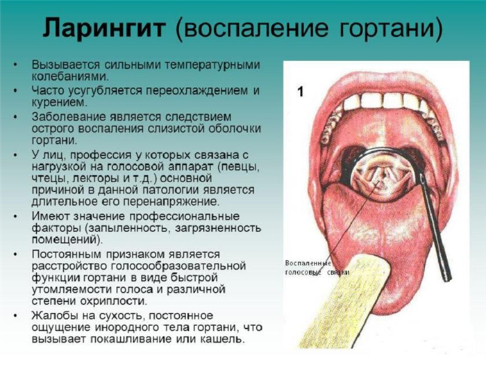 Чем характеризуется ларингит