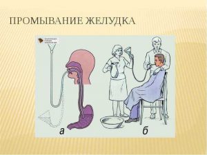 Процедура промывания желудка