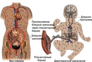 Развитие врожденного сифилиса