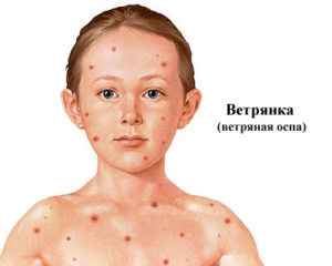 Ветрянка