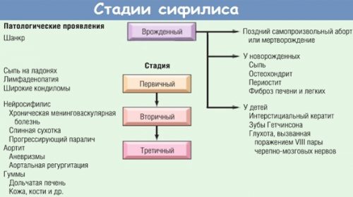 Стадии сифилиса