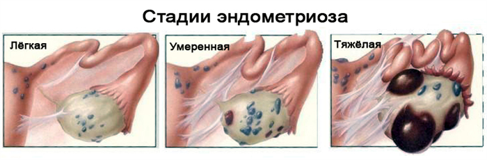 Стадии эндометриоза