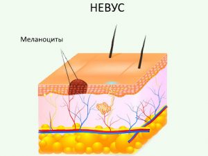 Строение невуса