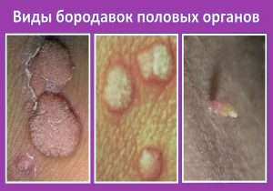 Виды бородавок половых органов