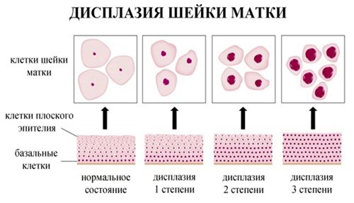 Дисплазия шейки матки