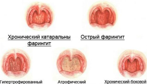 Виды фарингита