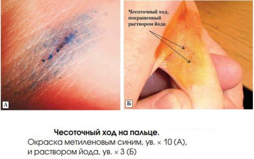 Окрашивание чесоточного хода