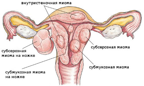 Саркома матки