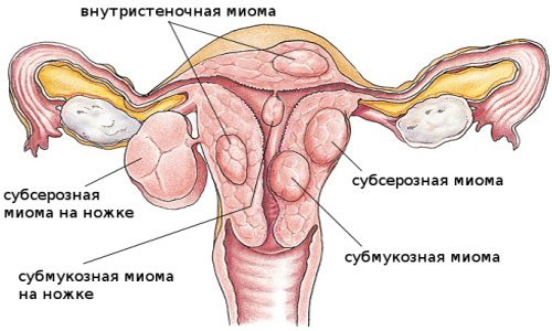 Виды опухолей