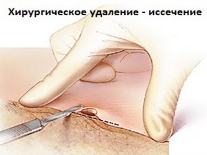 Проведение хирургического иссечения