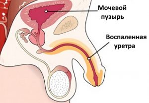 Уретрит