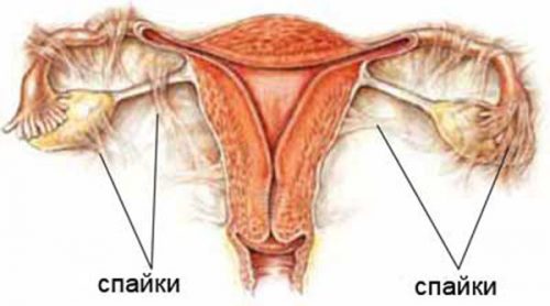 Спайки маточных труб