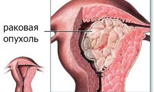 Раковая опухоль матки