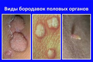 Виды генитальных новообразований