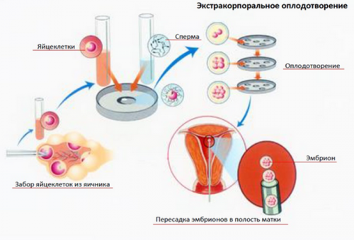 Схема экстракорпорального оплодотворения