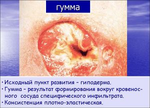 Гумма